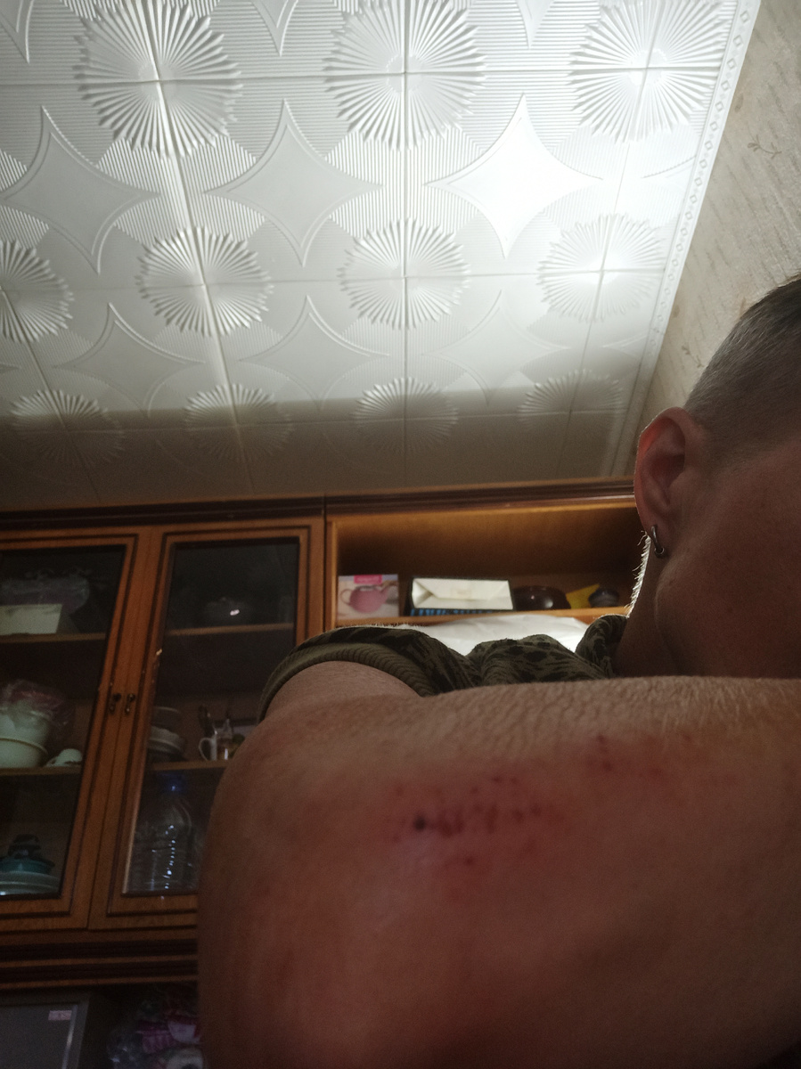 Возможно,это произошло потому,что локоть взял на себя часть удара.