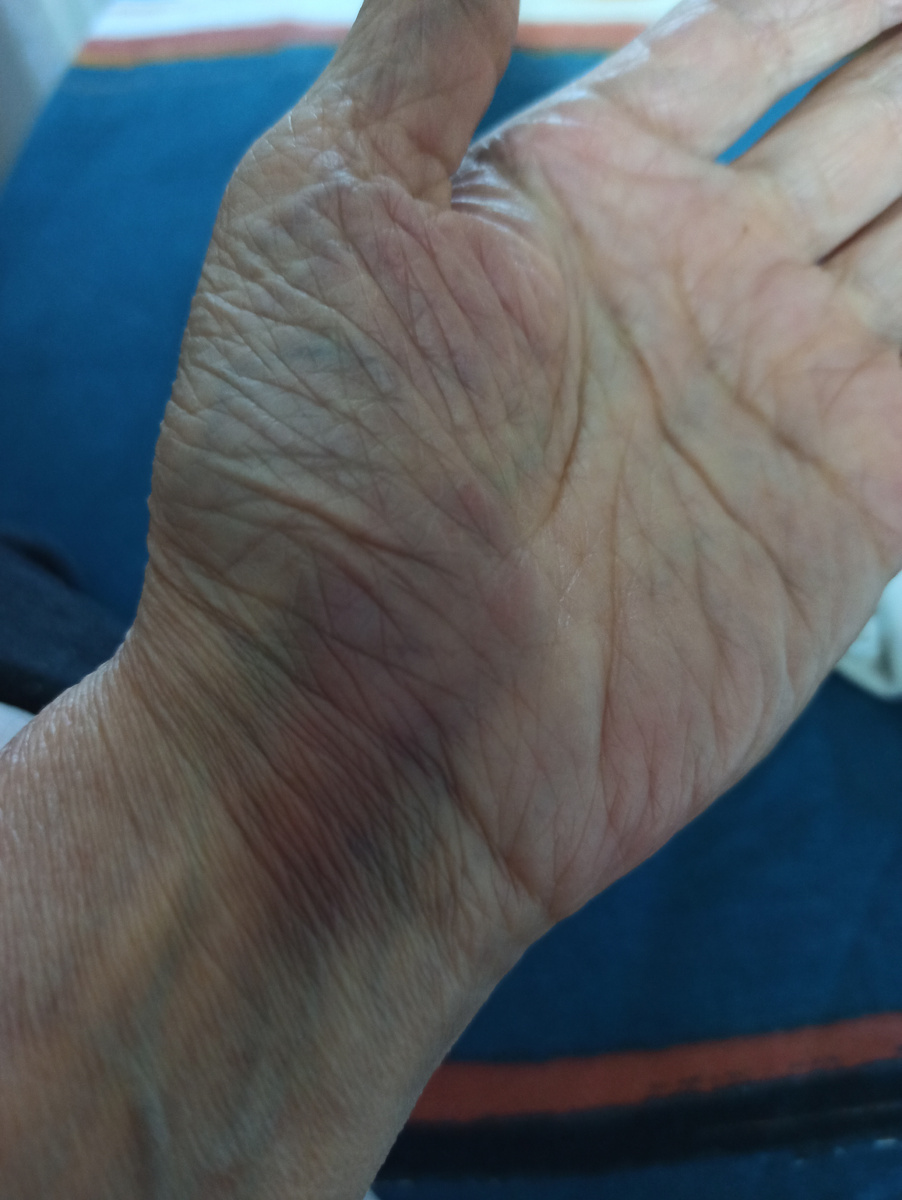 А также внутренняя часть лучезапястного канала.