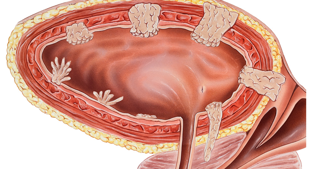 Рак мочевого пузыря. Что она скрывает?