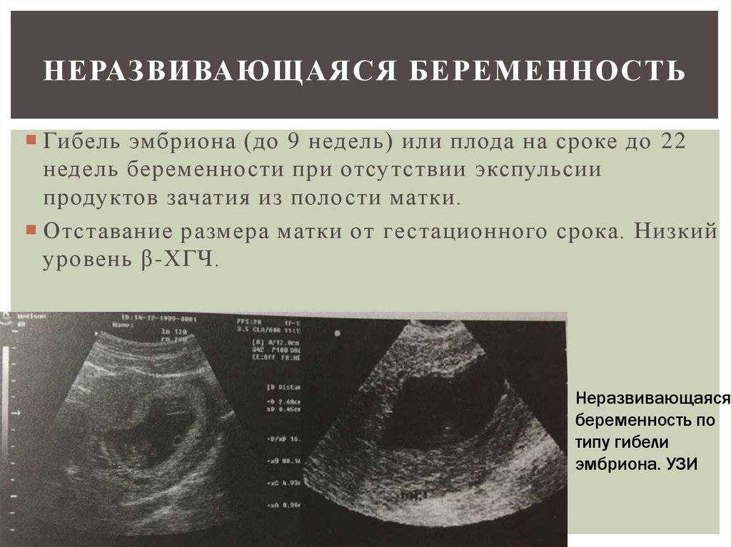 Замершая беременность - признаки, причины и симптомы