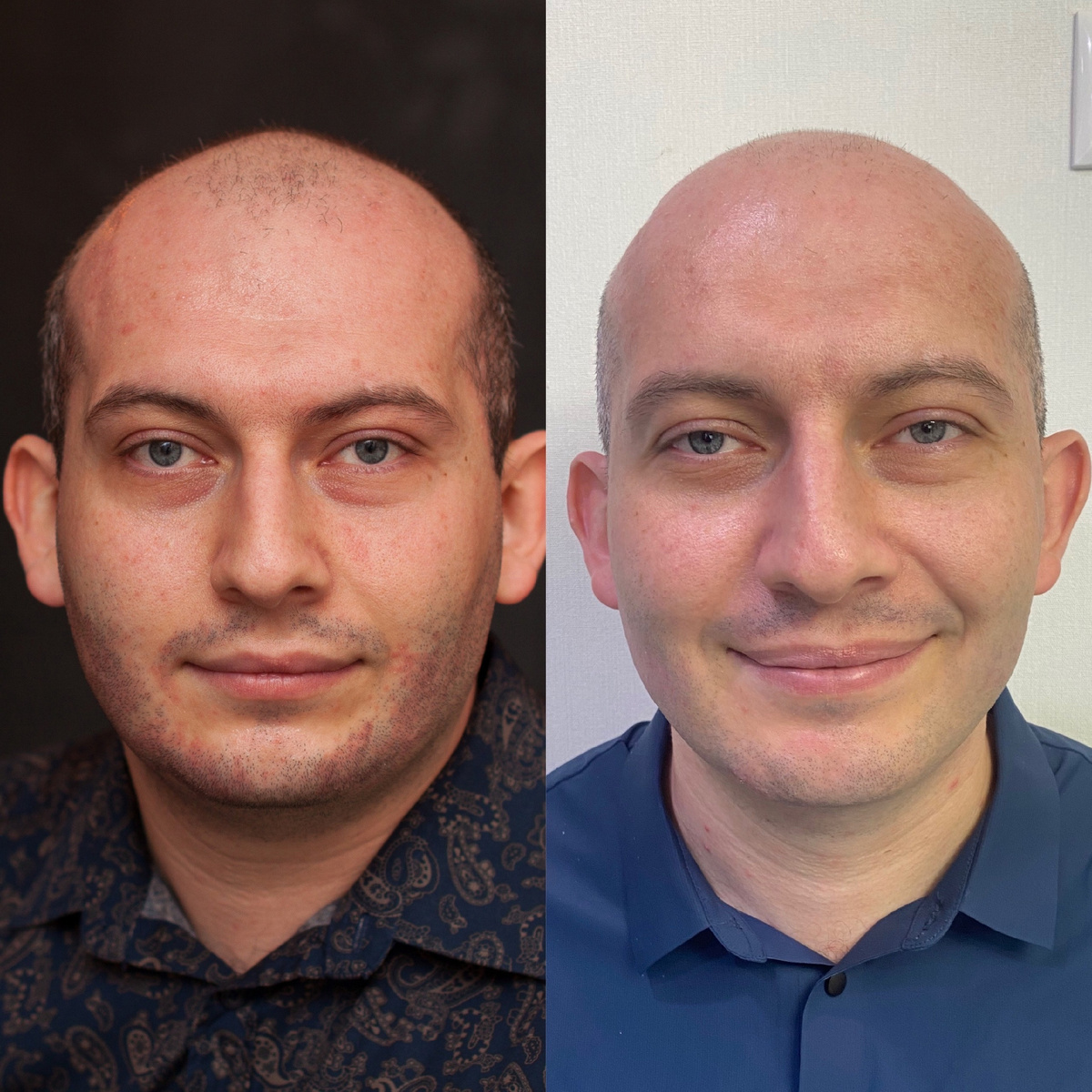 У моего мужа много лет себорея. Она проявляется у него на коже головы, на лице и груди.

Себорейный дерматит (себорея) — хроническое заболевание, которое проявляется воспалением и шелушением кожи. Чаще всего очаги себореи возникают в местах с большим количеством сальных желёз.

Факторы, повышающие риск развития себорейного дерматита:

- гиперактивность сальных желёз;
- нарушение структуры или функций эпидермиса;
- высокий уровень мужских половых гормонов (андрогенов);
- заболевания кожи (розацеа, псориаз, акне);
- нарушения работы желудочно-кишечного тракта;
- нарушения обмена веществ.

В мае месяце мы приняли решение опробовать кейс от нашей компании.

⃣Первым этапом он прошел курс Детокса, который состоит из трех этапов: кишечник, почки, печень. После первого этапа "кишечник" подключили по одной монодозе биодрона.

BioDrone — активный комплекс гуминовых кислот, способствующих мощной поддержке и укреплению иммунитета на клеточном уровне.
Поддержка и укрепление иммунитета.Помощь в борьбе с аллергенами. Антиоксидантная защита. Иммуноактиватор на основе гуминовых веществ.

⃣Вторым этапом он начал принимать витамин Д и Be Best Male.
В составе нового БАДА есть Корень смилакса ☝🏼
Он обладает антибактериальными, антисептическими, антиоксидантными, заживляющими, улучшающими пищеварение, омолаживающими, противосифилитическими свойствами. А также антиотечными, желчегонными, потогонными, тонизирующими, мочегонными, антиспазмическими, противовоспалительными, восстанавливающими нервную систему и кровоочистительными свойствами.

Сейчас я покажу к какому результату он пришел.

⃣Третьим этапом начнет пить наш коллаген по 2 стика и бьюти бленд в комплексе.

Для самостоятельных покупок и накопления кэшбэка в 3,5,7,10 %: https://www.nlstar.com/ref/cc/XQJ43J/