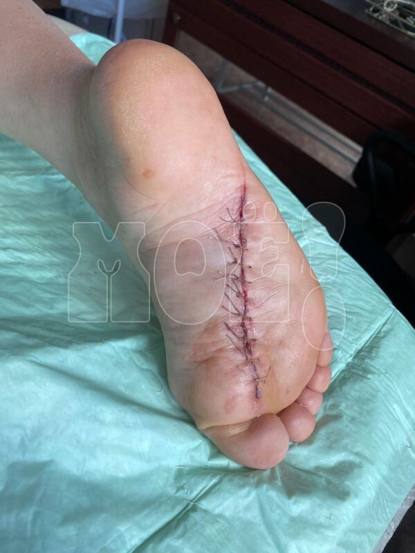      Травма, которую получила Ирина. Фото героини материала