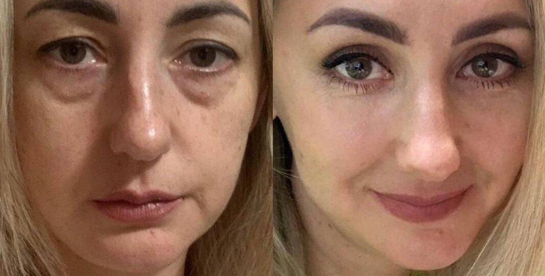 Как можно убрать жировые грыжи на веках