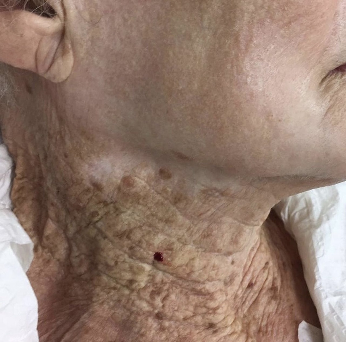 На фото женщина 92 лет, которая наносила SPF кремы ( только на лицо)всю сознательную жизнь. Но никогда не ухаживала за кожей шеи. Как вам результат?