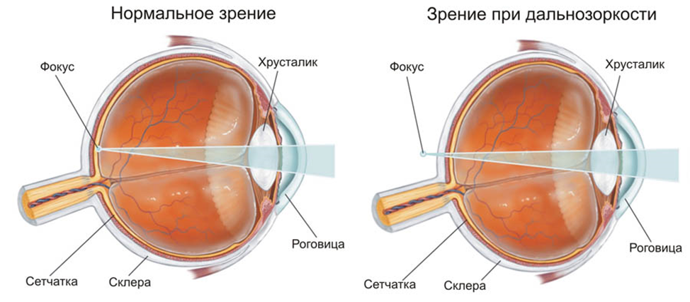 Слабая пресбиопия