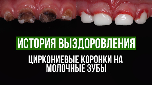 Циркониевые коронки на молочные зубы / История выздоровления!