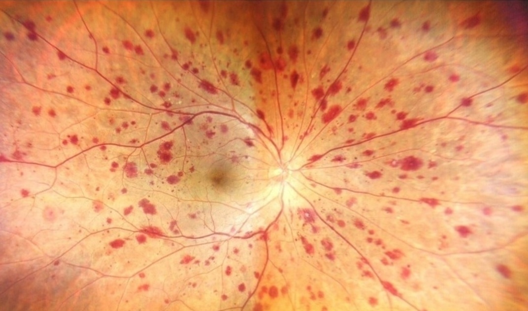Пятна Рота - мелкие кровоизлияния в сетчатку глаза.