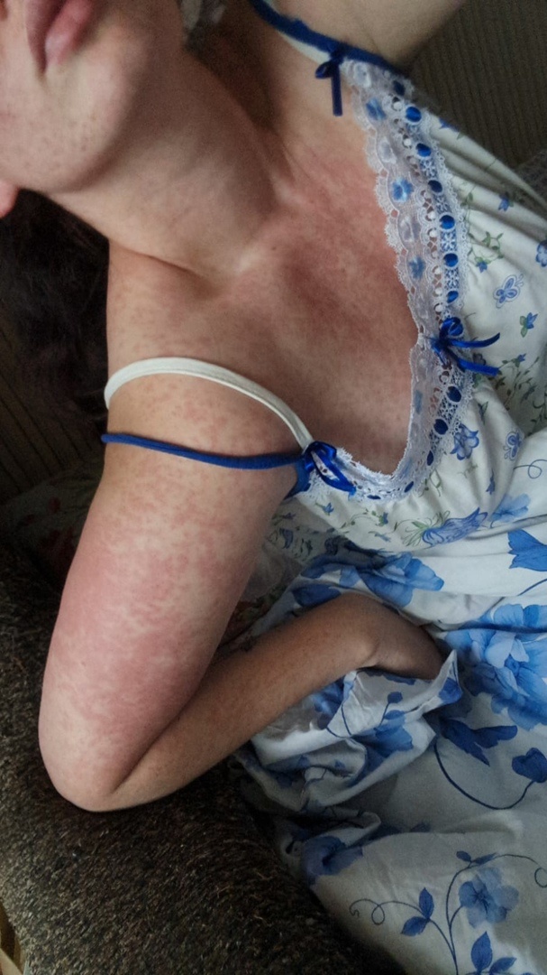 Крапивница (аллергическая реакция)