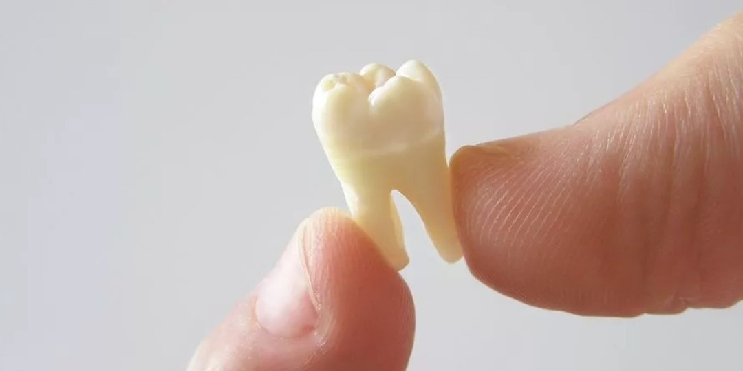 Что делать, если выпал зуб?