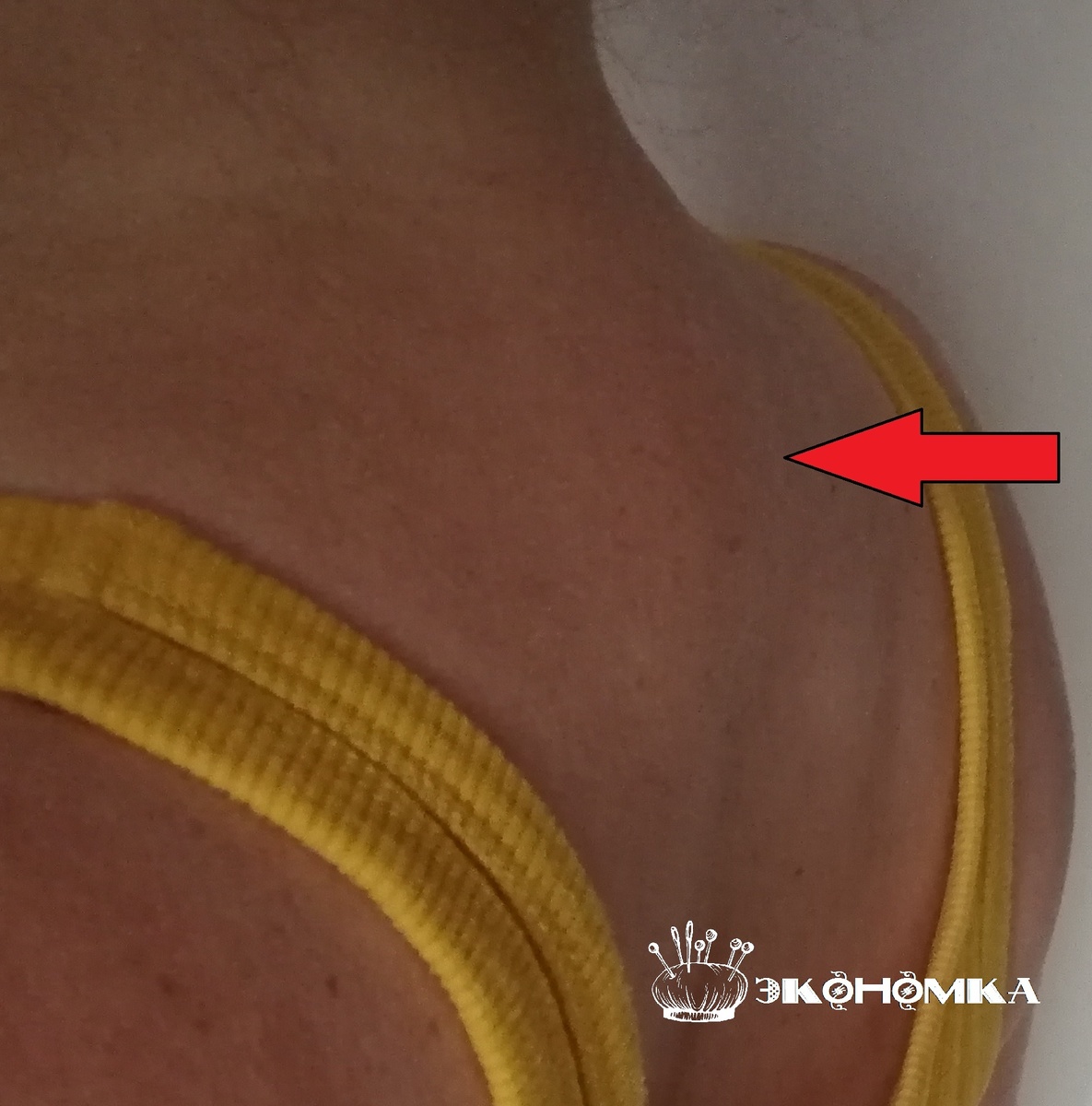 Как убрать холку на шее