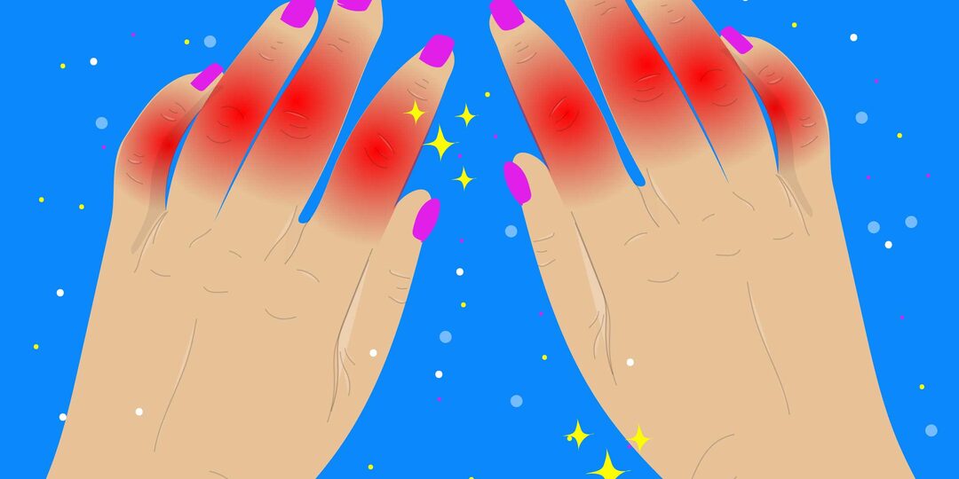 Артрит: симптомы, виды и причины. Диагностика и лечение артрита — объясняет врач