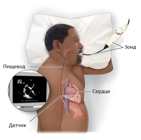 Чреспищеводная эхокардиография - что это и как делается?