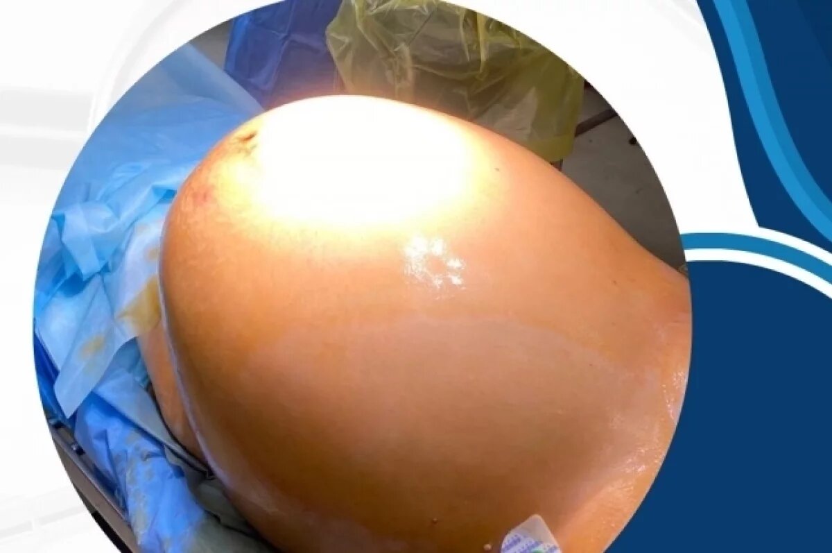    Во Владивостоке спасли женщину с почти 40-килограммовой опухолью