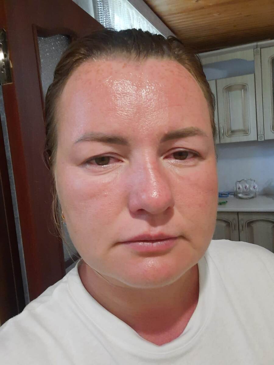 Лицо опухло от солнечного ожога.