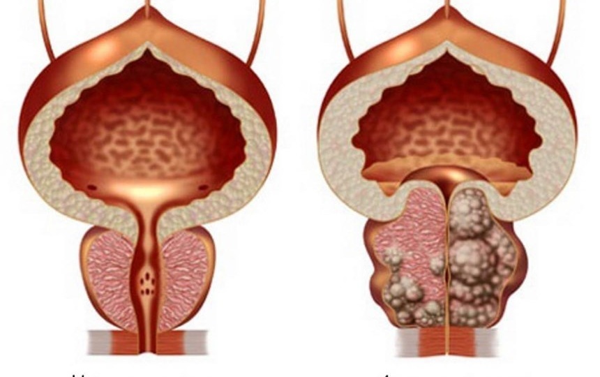 Рак предстательной железы. Болезнь каждого мужчины.