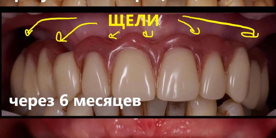 "Ноу-хау" в тотальной имплантации, от которого стоит держаться подальше. Показываю атрофию кости наших пациентов