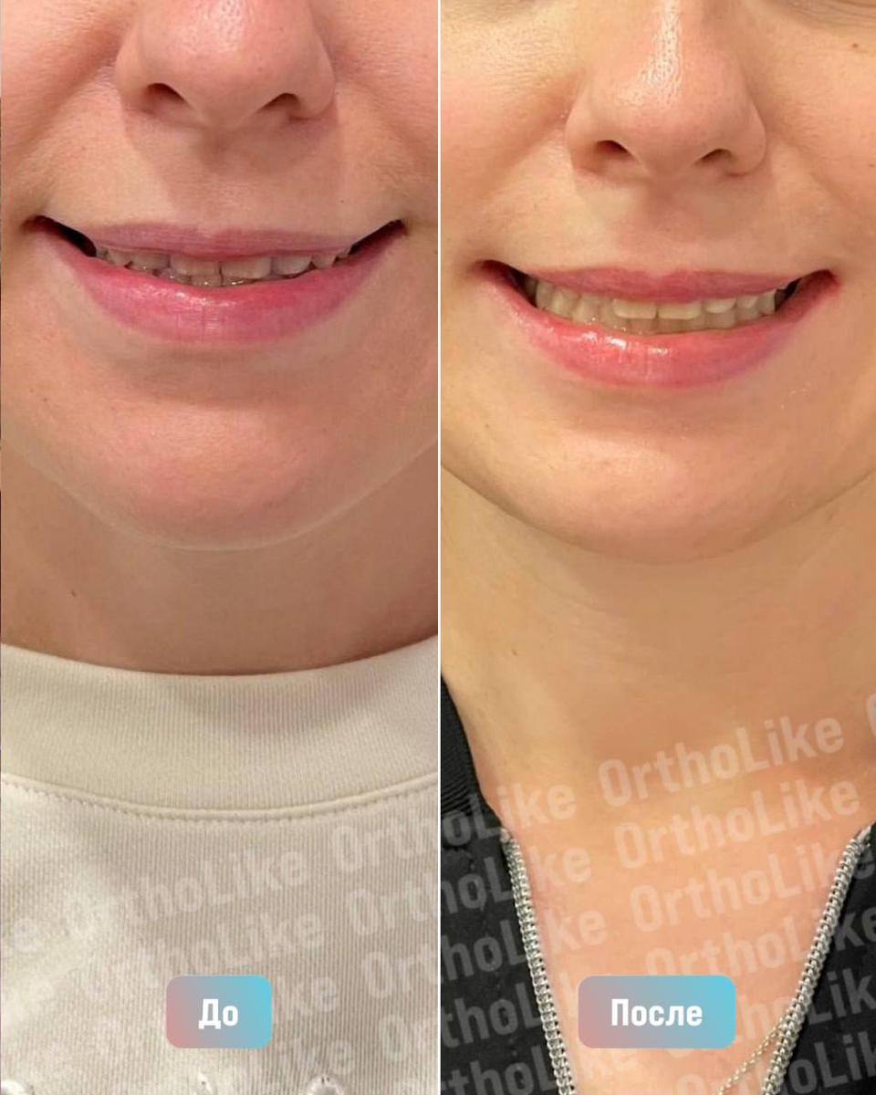 До и после лечения