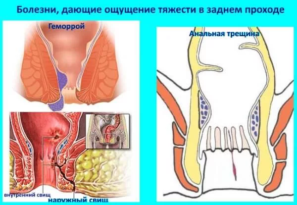 Что такое анальные бахромки, чем они опасны, и как их лечить