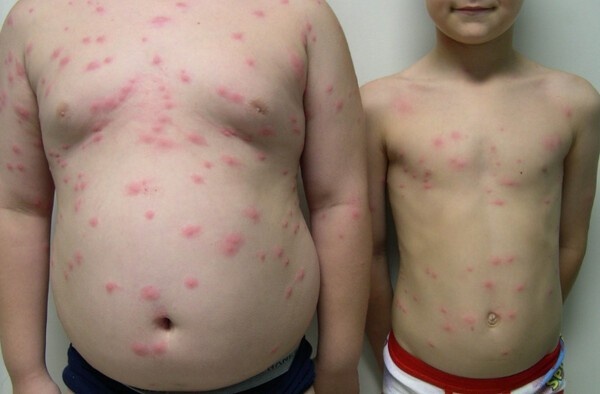 Влияние на экосистему: Церкариоз не только влияет на здоровье человека, но и играет важную роль в экосистемах водоемов. Личинки церкарий являются частью сложного жизненного цикла, который включает моллюсков и водоплавающих птиц, что помогает поддерживать баланс в водной экосистеме.