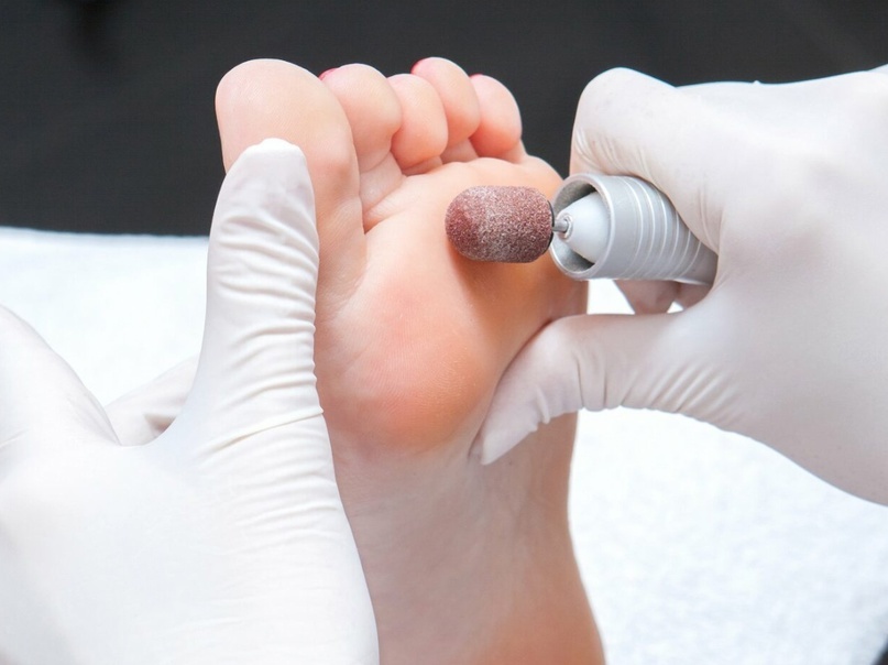 Подологическая обработка стопы
