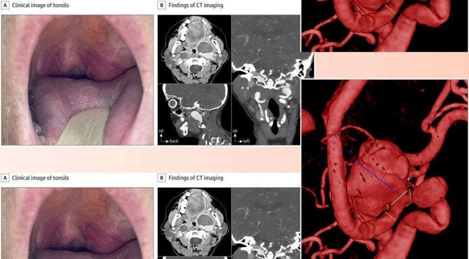   N + 1; Elena Al Hakim et al. / JAMA Otolaryngology–Head & Neck Surgery, 2024