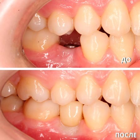 В итоге, вы увидите лишь коронку в полости рта, которая ничем не будет отличаться от ваших собственных зубов.