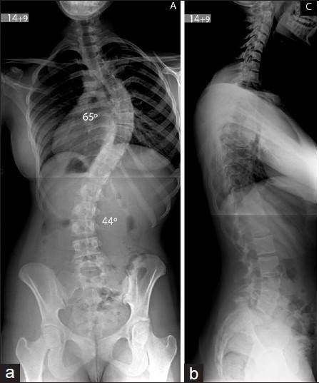 Обзорный рентген позвоночника. Фото из открытых источников