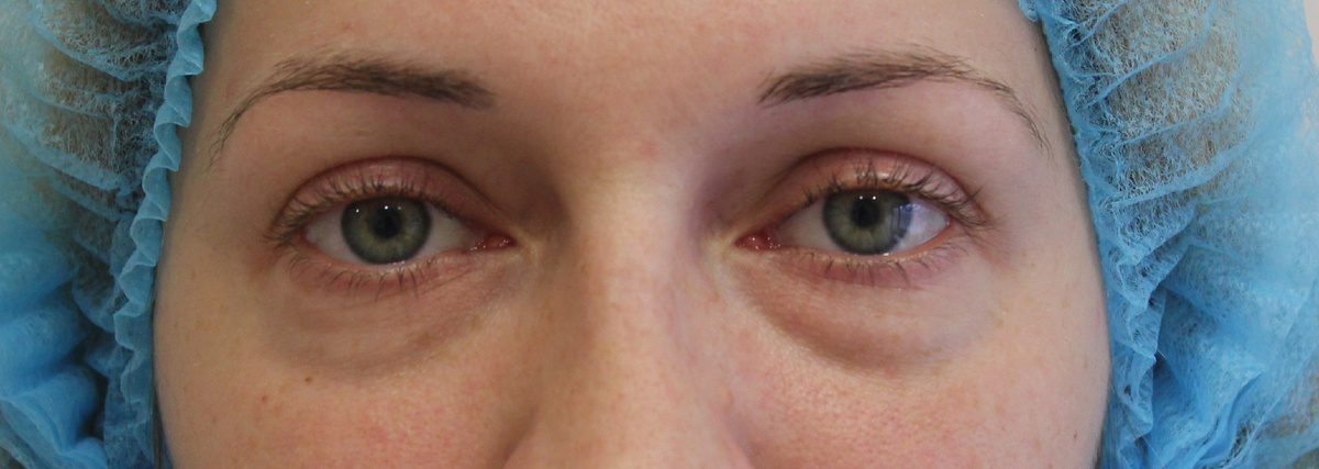 "Мешки" под глазами придают внешнему виду усталость