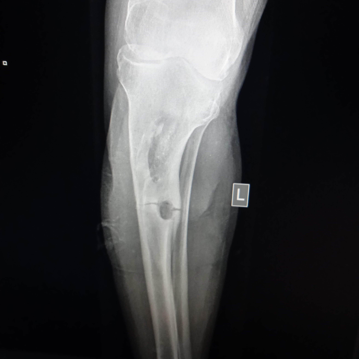 Картина остеомиелита после МОС