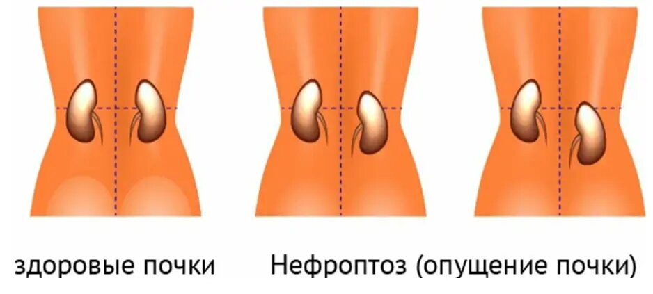 Опущение почки при дефеците коллагена