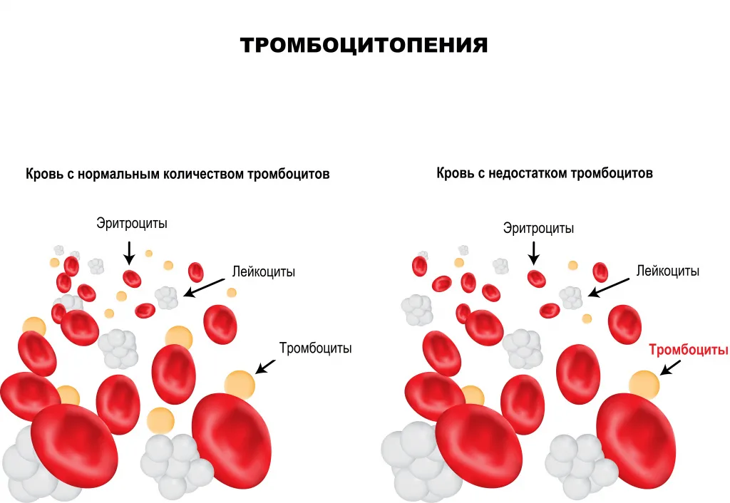 Почему снижены тромбоциты