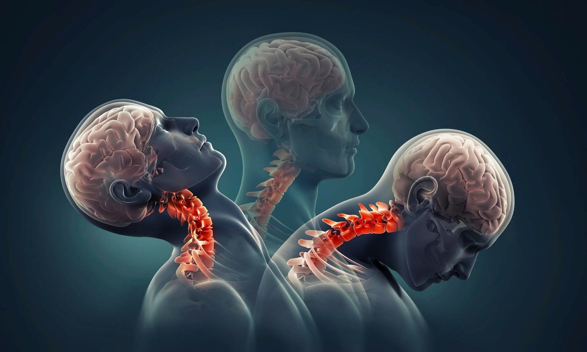 Механизм образования хлыстовой травмы