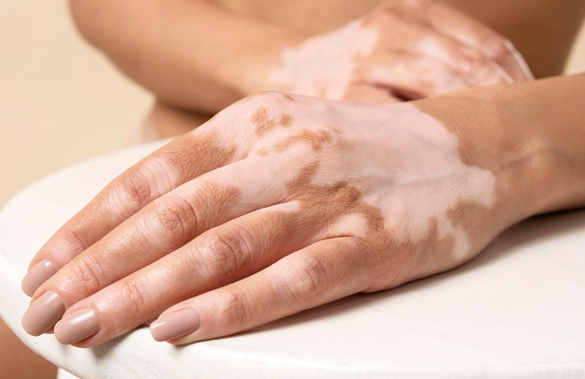 Витилиго — главное о заболевании