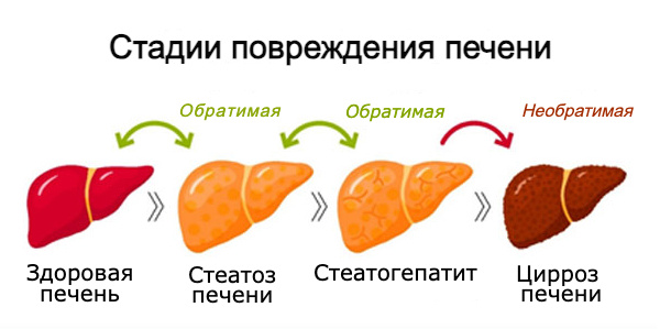 Стадии повреждения печени
