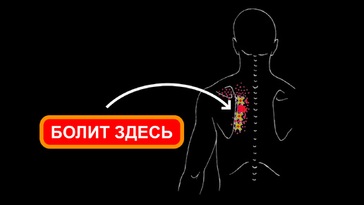 Боль между лопаток