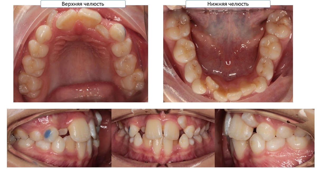 И как уже говорили на первом этапе мы удаляем нижние "восьмерки" в 8 лет