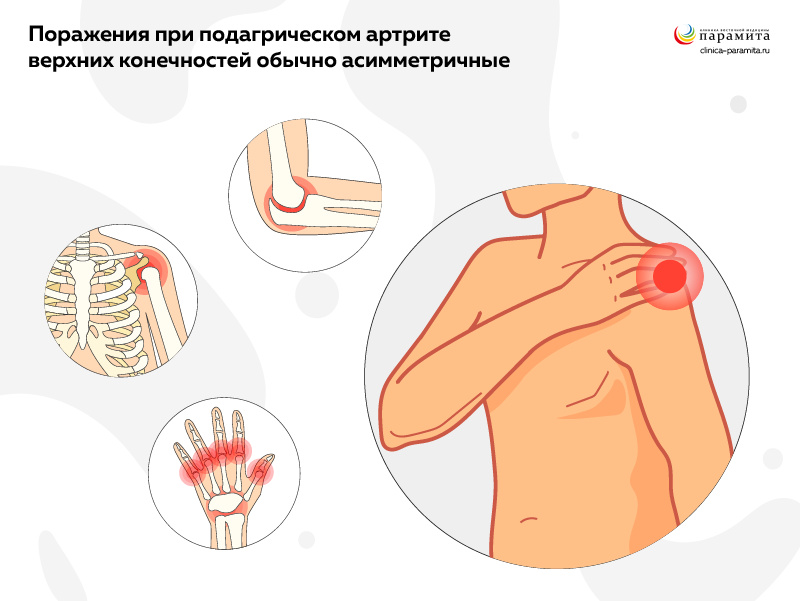 Подагрический артрит верхних конечностей