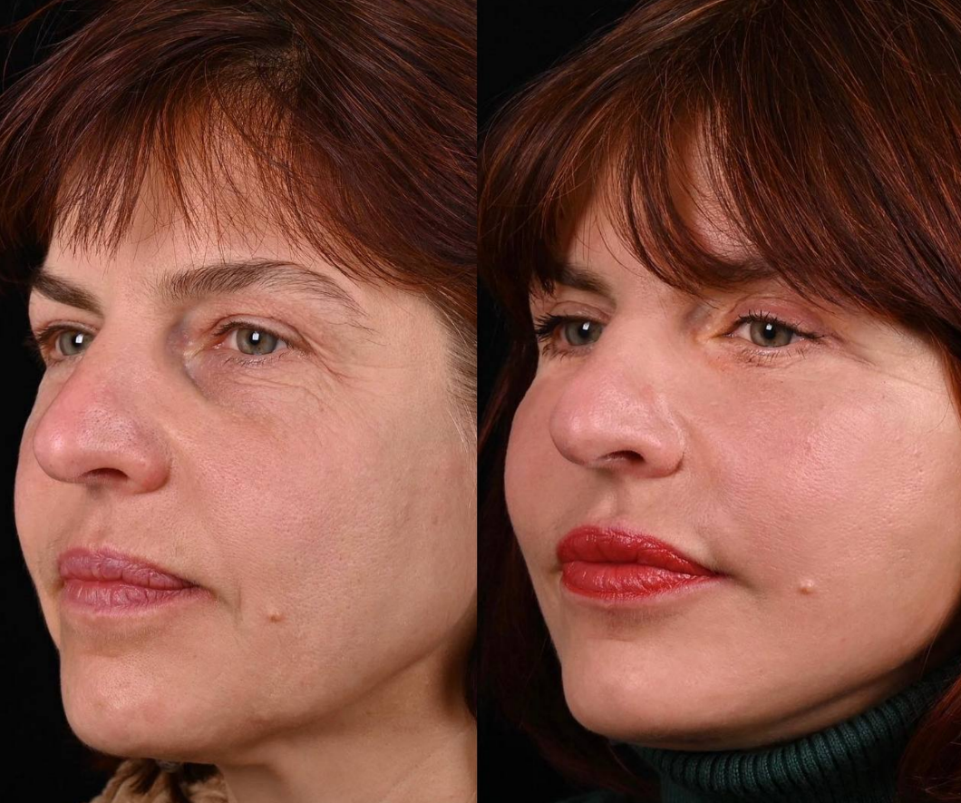 Пластика верхних век с липофилингом, пластика нижних век с липофилингом, Пластика лица и шеи MACS-lift и лифтинг лица. Фото до и после. Фото с сайта хирурга Д.Р. Гришкяна. Имеются противопоказания, требуется консультация специалиста