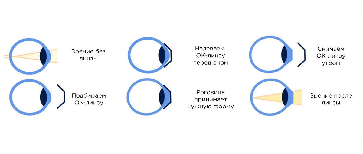 Под воздействием этих линз слезный слой, зажатый между линзами и роговицей, изменяет толщину эпителия.