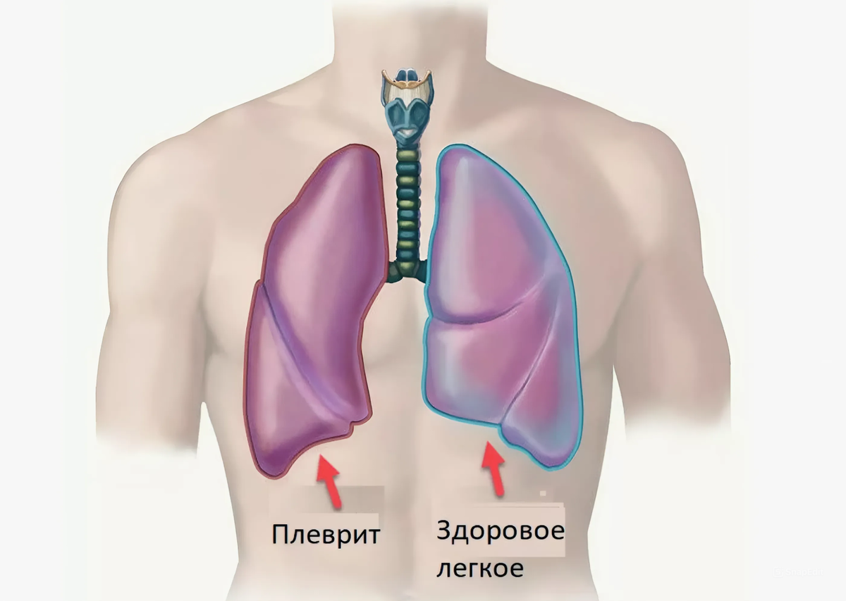 Существует несколько различных причин боли в спине, многие из которых могут усиливаться при дыхании.-5