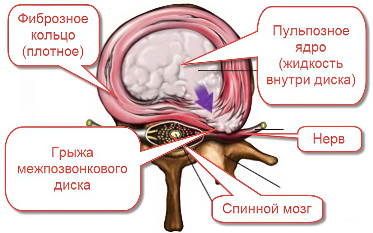  Пульпозное ядро - это желеобразная субстанция, которая расположена в позвоночнике и является частью межпозвонкового диска.-3