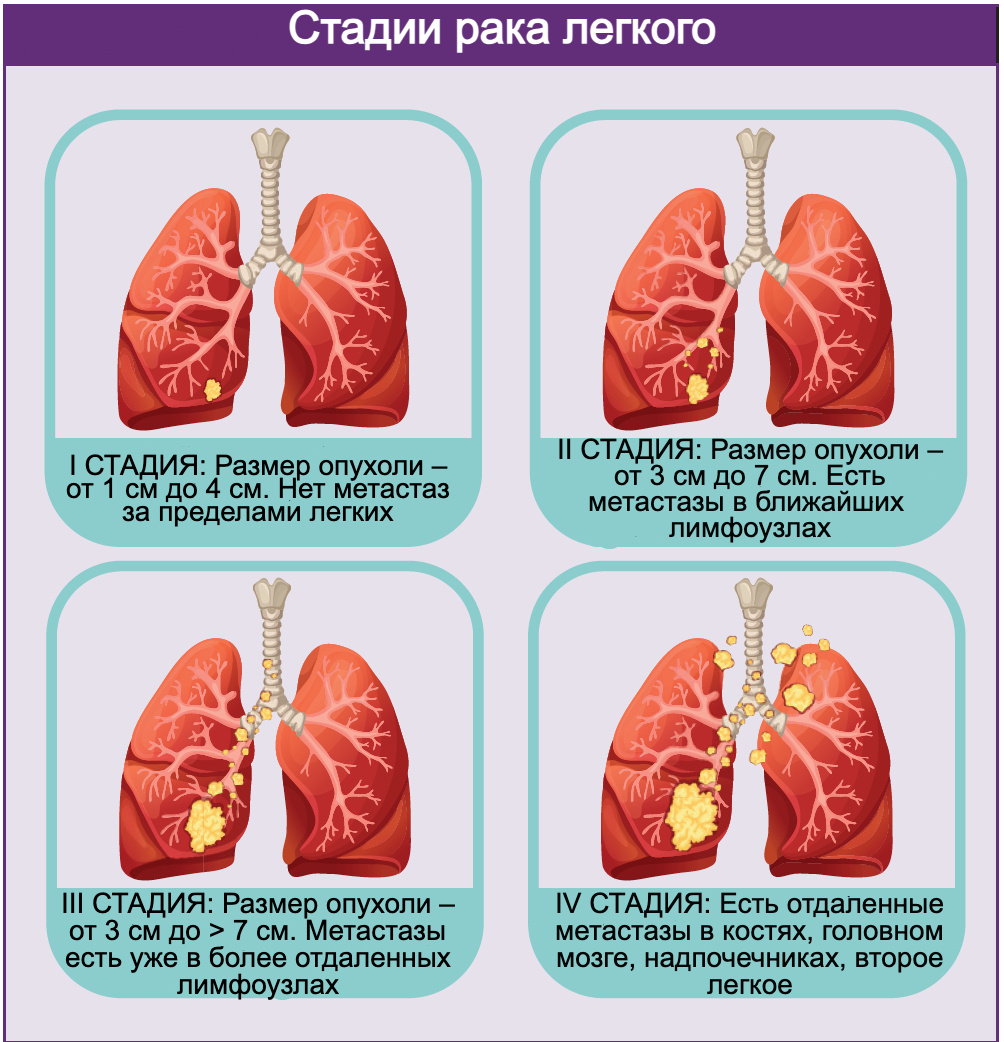 Стадии рака легкого