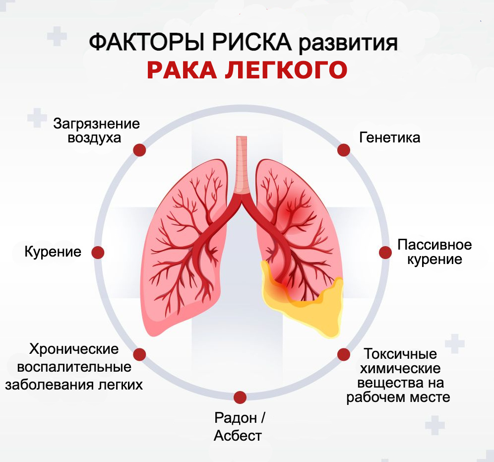 Факторы риска развития рака легкого