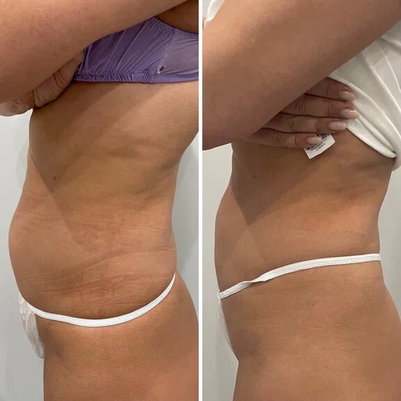 Сочетание криолиполиза с процедурой Venus Legacy