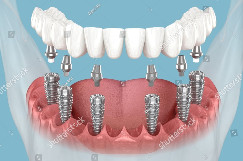 Модель имплантации All-on-6 на нижней челюсти