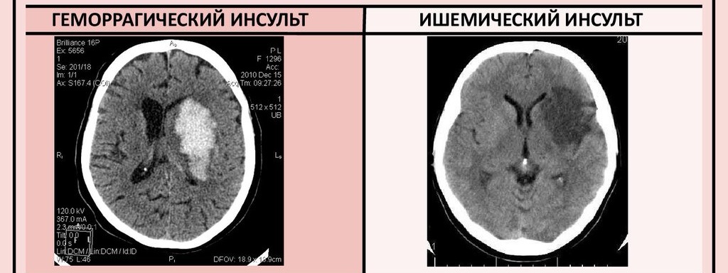 Как выглядит инсульт на компьютерной томографии головного мозга 