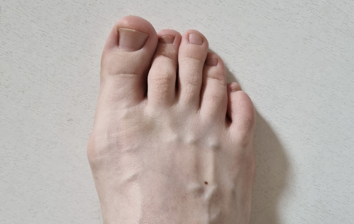 Молоткообразная деформация II пальца стопы