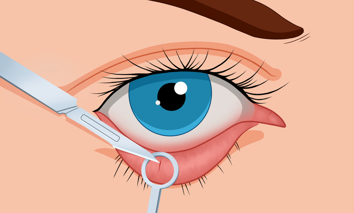 Операция по удалению халязиона.