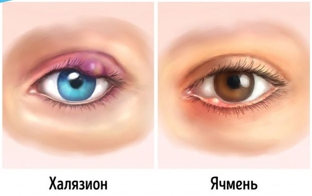 Отличие халязиона от ячменя. У меня халязион появился на нижнем веке. Фото прикладывать не буду, а то статью заблокируют за шокирующий контент.