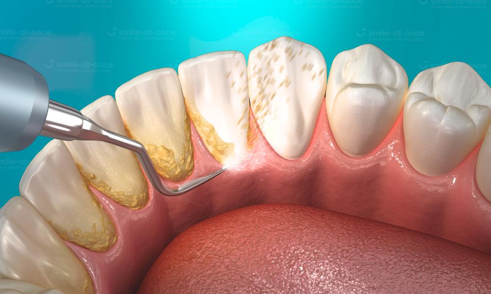 Здесь проиллюстрирован пример чистки ультразвуковым скейлером, который разбивает и убирает зубной камень. Фотоколлаж: Smile-at-Once.ru